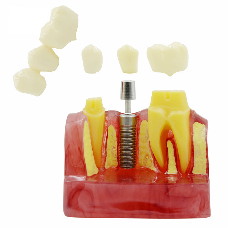 Dental Implant Analysis Crown Bridge Demonstration Teeth Model Dental Implant Teeth Model